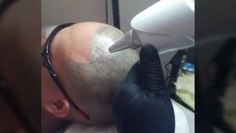 Hair Tattoo Removal Tattoo hair laser removal
