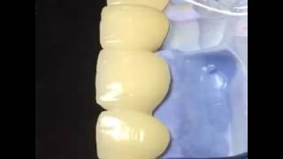 Zirconia layered & solid bruxzir