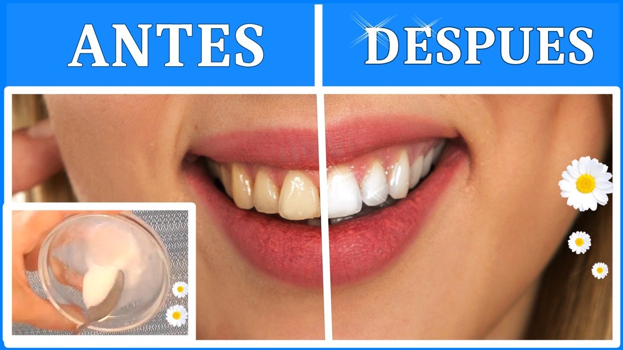 Cuánto cuesta hacer un blanqueamiento dental