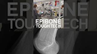 TOUGH TECH: EPIBONE #short
From the research bench to a groundbreaking biotech: see how Biomedical Engineering alums are revolutionizing orthopedic care with lab-grown tissues!
Their startup, EpiBone, created innovative technology that allows surgeons to use a patients own cells instead of traditional materials — setting a new standard in addressing orthopedic injuries.
Watch our latest Tough Tech episode featuring co-founders Nina Tandon PhD09, 12BUS and Sarindr Ik Bhumiratana PhD12 as they discuss this game-changing advancement with Professor Harry West.
Watch the full video on our youtube channel
Music Credits: All from Free Music Archive (FMA)
Take it Back by Crowander. Attribution-NonCommercial 4.0 International License. Symphonic Choir Arpeggio - I - Variation I.mp3 by Gregor Quendel.Attribution-NonCommercial-NoDerivatives 4.0 International License. Theme in G by Podington Bear. Attribution-NonCommercial 3.0 International License. Planet Hope by Denys Kyshchuk. Attribution-NonCommercial-NoDerivatives 4.0 International License. Bach - Invention No. 13 in A Minor - BWV 784 (Arr. for Strings).mp3 by Gregor Quendel. Attribution-NonCommercial-NoDerivatives 4.0 International License. TOUGH TECH: EPIBONE #short