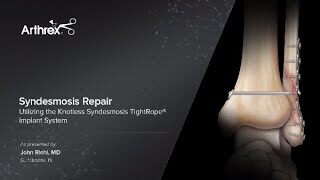 Syndesmosis Repair Utilizing the Knotless Syndesmosis TightRope® Implant System