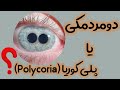 مردمک اضافه در چشم دومرمکی یا پلی کوریا چیست