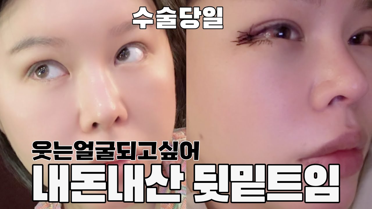 내돈내산 눈 뒷밑트임 성형수술 당일 후기 - 마취깨고