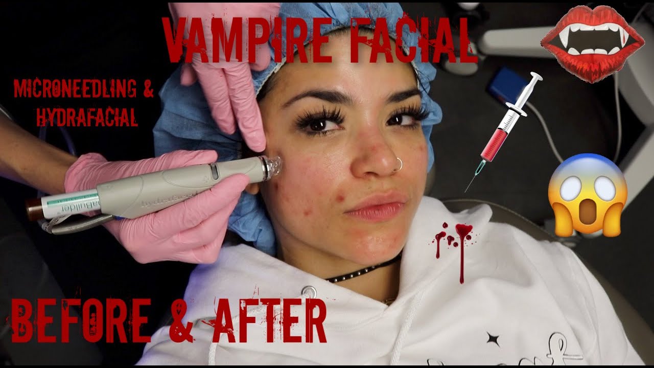 VAMPIRE FACIAL, MICRONEEDLING, & HYDAFACIAL EXPERIENCE IN NYC! YouTube