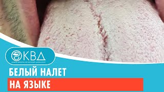 👅 Белый налет на языке. Клинический случай №386