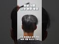비절개 모발이식의 삭발 유형(부분 삭발, 전체 삭발, 무삭발)