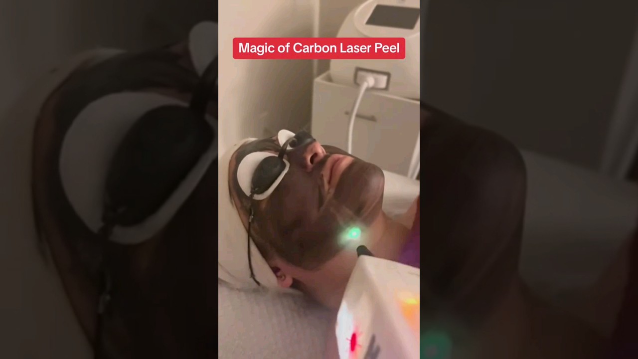 Achieve Flawless Skin with Carbon Laser Peel Facial Treatment in Milton and Nearby Areas