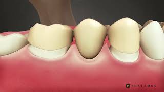 Bridge to Replace Missing Tooth Spanish
