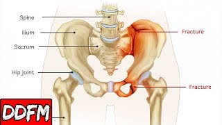 The Most Common & Overlooked Motorcycle Crash Injury