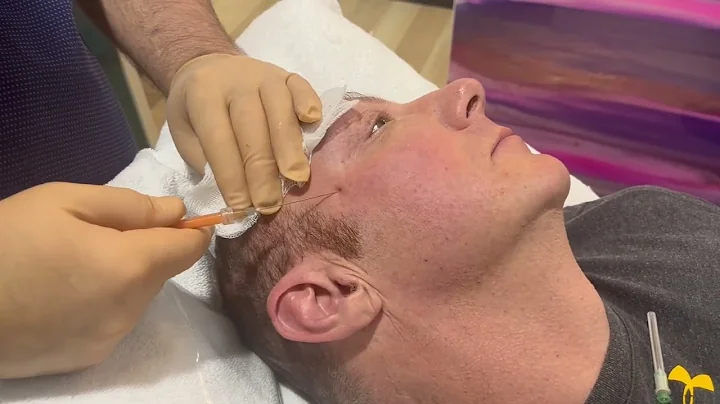 Dr. Mark Jeffery does a scar revision with Nano fa...