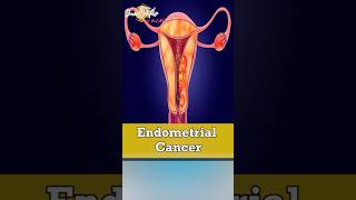 What Every Woman Should Know About Endometrial Cancer
