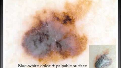 Melanoma criteria 2/3 by Dr. Giuseppe Argenziano