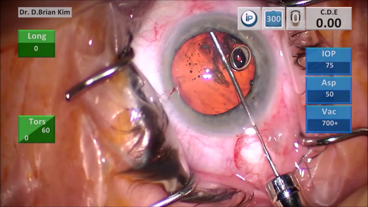 http://clinicaltrials.gov Easy; One-Step; and Consistent Hydrodissection Technique