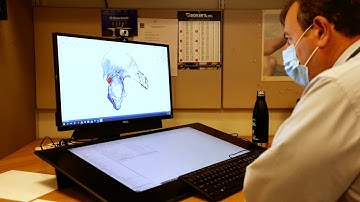 3D Printing of Complex Orthopedic Implants Fills Niche Role