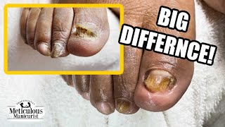 👣Best Pedicure Toenail Transformation (fixed version)👣