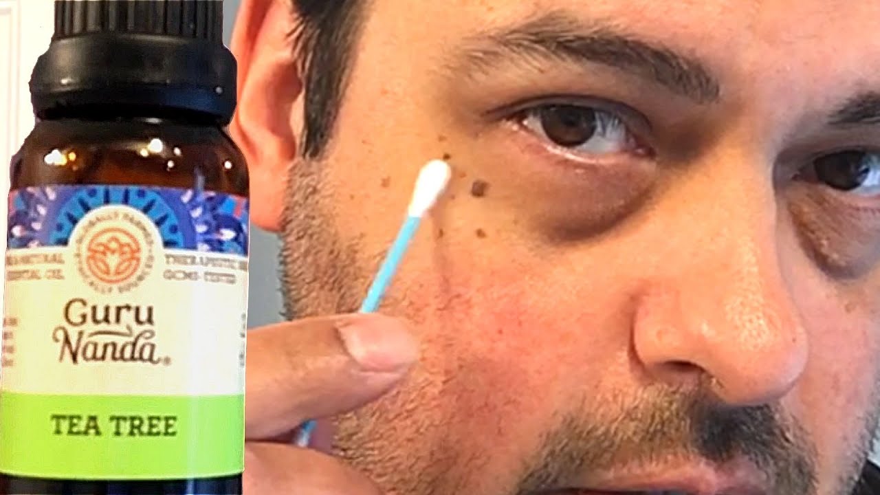 How To Remove Skin Tags With Tea Tree Oil  