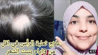 علاج ثعلبة الرأس بشكل نهائي او تونية في اقل من3ايام