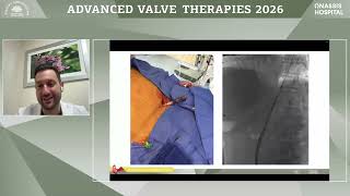 N. Spilias | Live in-a-box Case 5:  TAVR - Alternative access, University of Miami