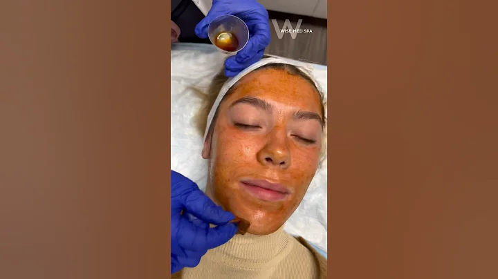 The VI Peel Purified Plus is used to minimize acne, scarring, and hyperpigmentation! #chemicalpeel