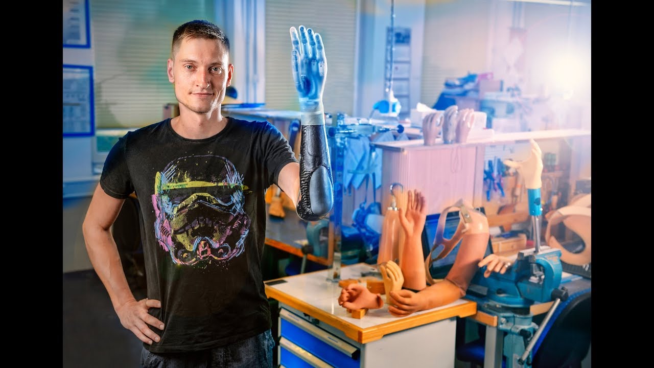 So lebt es sich mit einer Armprothese