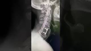 Daily Xray! Surgical Fusion in the Neck