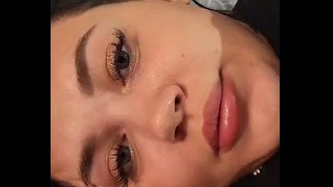 Understanding Vertigo Through Eye Movements | Patient Nystagmus & Dizziness Explained|