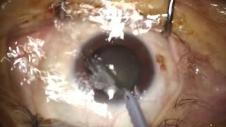 My cataract surgery #21 Soft cataract - one hand phaco screenshot 2