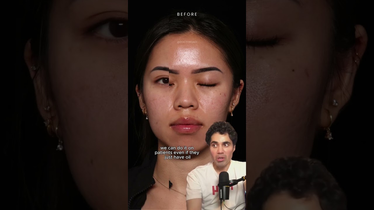 What Are The Treatments for Oily Skin?