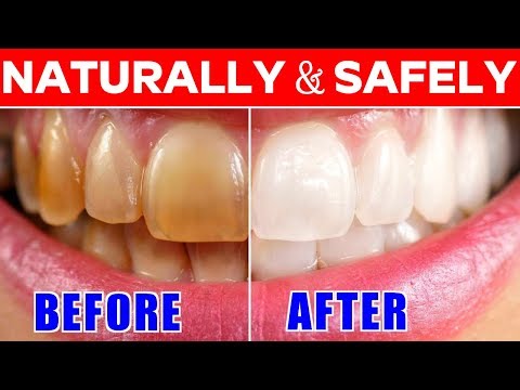 Teeth Whitening | Make your TEETH white and Shiny in 1 DAY | How To make Your Teeth White At Home