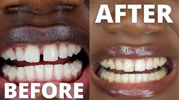 TEETH JOURNEY part 1| Invisalign Cost, Pain, Pros and Cons