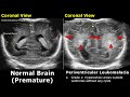 Neonatal brain ultrasound normal vs abnormal images  full term infant  premature newborn head usg