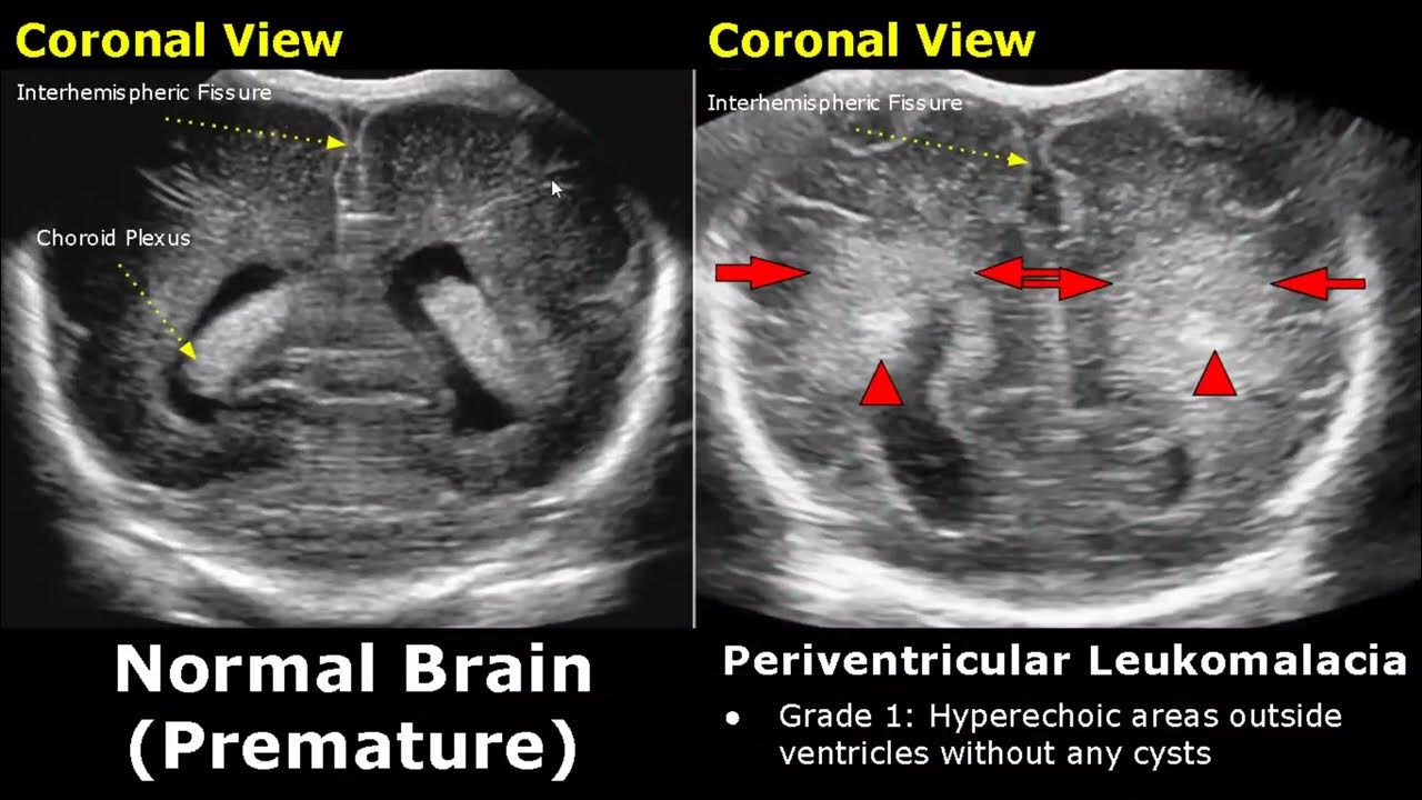 Neonatal Brain Ultrasound Normal Vs Abnormal Images Full Term Infant