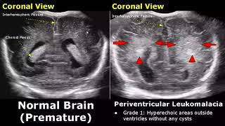 Neonatal Brain Ultrasound Normal Vs Abnormal Images | Full Term Infant & Premature Newborn Head USG