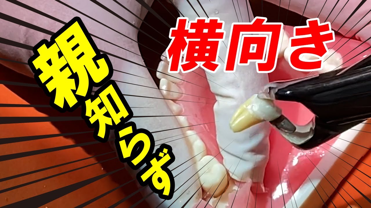 痛い？横向きの親知らず抜歯方法を岡山の歯医者が解説！