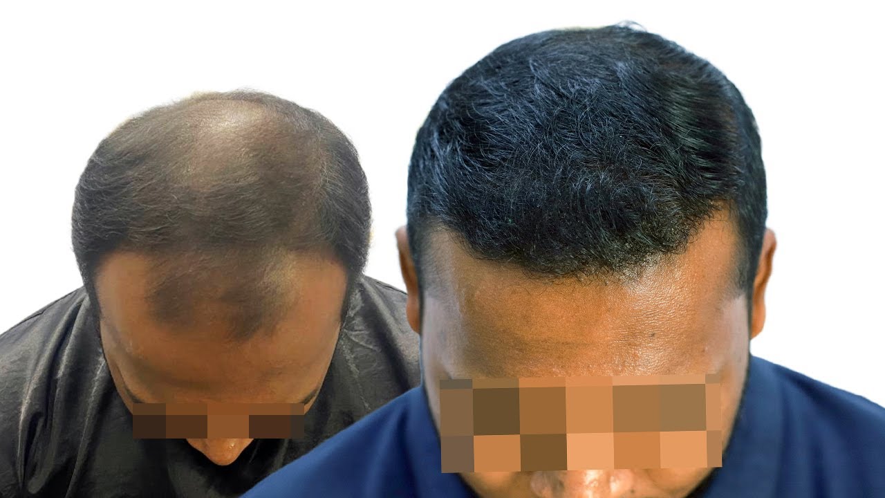 Hair Transplant Raipur Chhattisgarh Hair Transplant In Raipur Cost