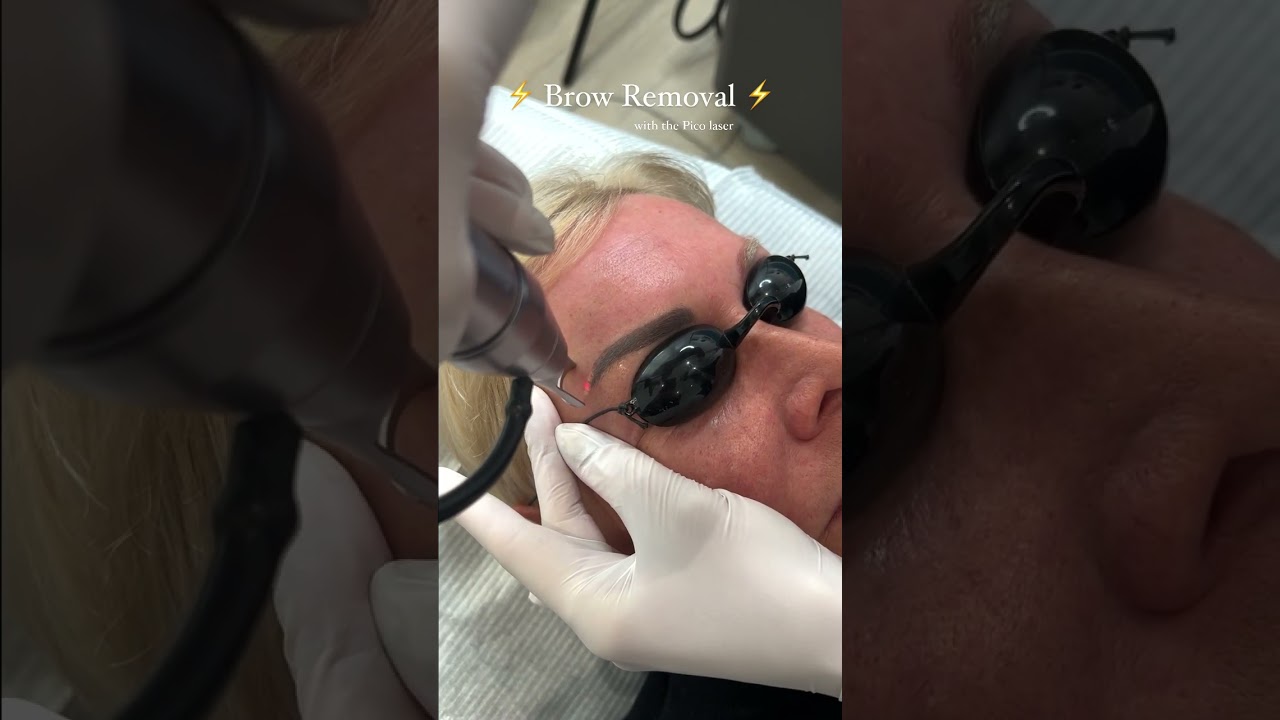 Eyebrow Tattoo removal with the Pico laser