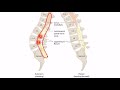 Lumbar Radiculopathy for the USMLE Step 1