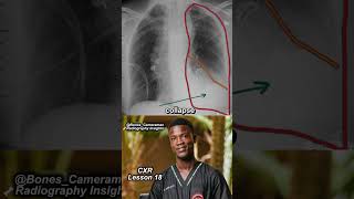 Aortic Dissection on Chest X-Ray | How to Identify It in 60 Seconds