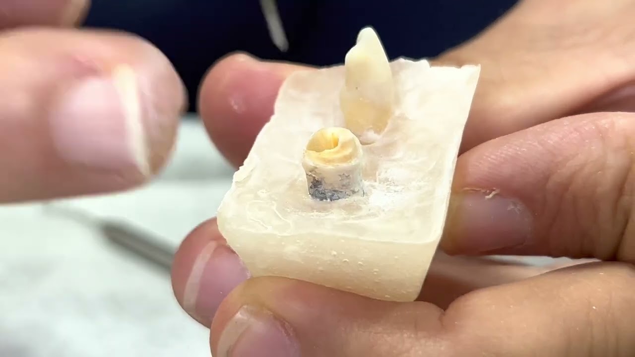 Reconstrução Coronária. Núcleo Metálico Fundido, PARTE II.