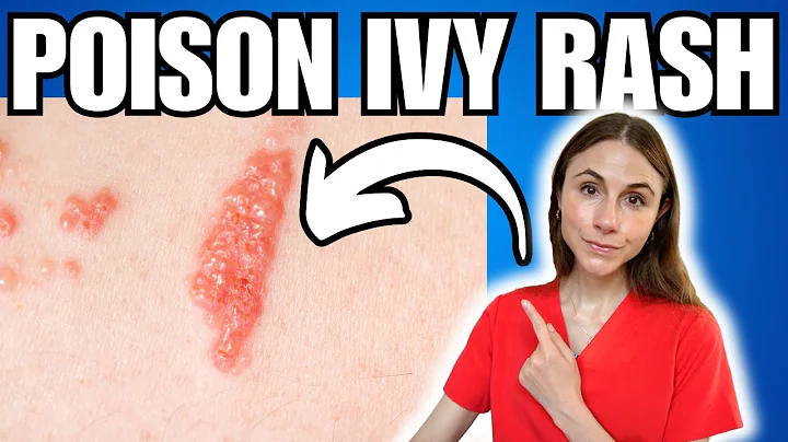 Get Rid Of Poison Ivy Rash FAST