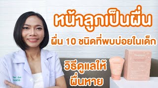 ผื่นที่หน้าลูก ผื่น10ชนิดที่พบบ่อย ดูแลลูกอย่างไรให้ผื่นหาย