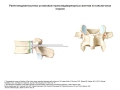 Рентгенологические критерии установки имплантов в позвоночнике.