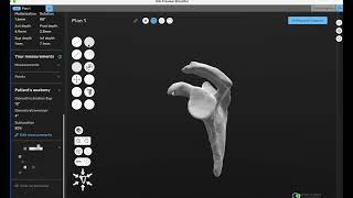 Planning a Reverse Shoulder Replacement with ProVoyance Software - Dr. Paul Kiritsis