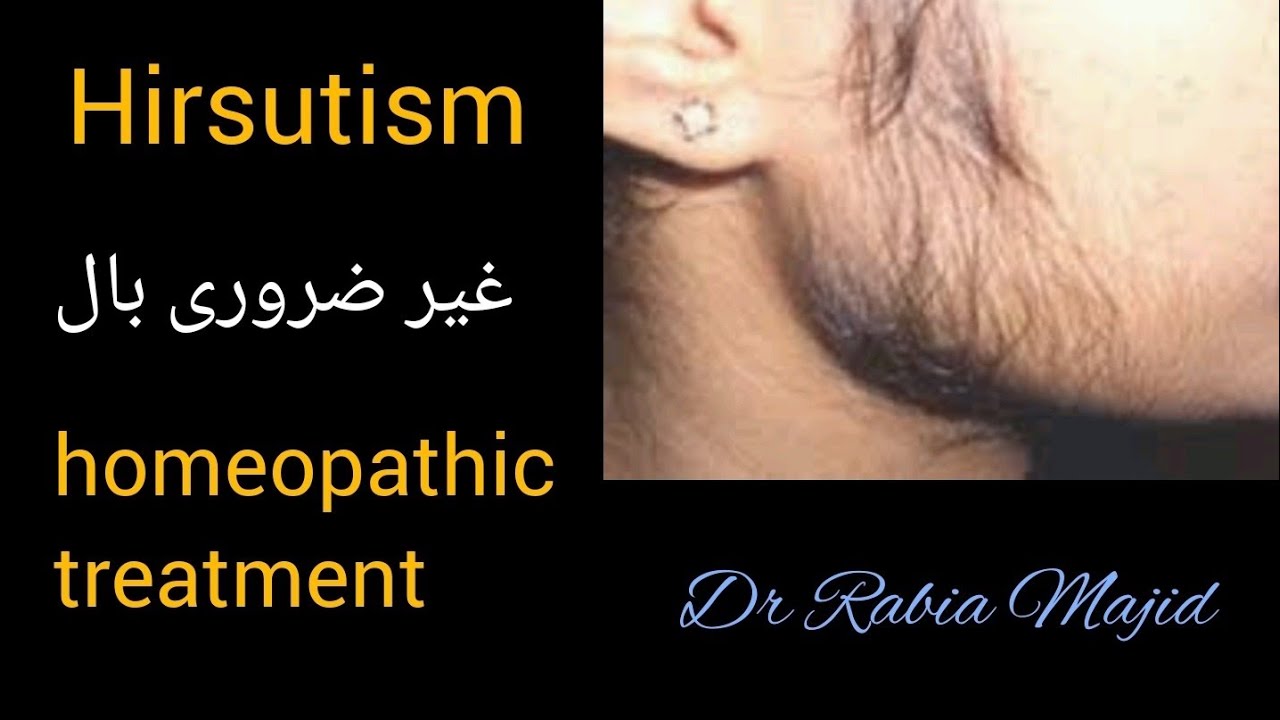 Hirsutism Abnormal Hair Growth reason And Treatment Urdu hindi Dr hirsutism-abnormal-hair-growth-reason-and-treatment-urdu-hindi-dr