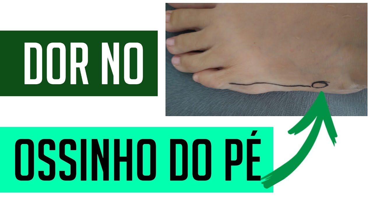 4 EXERCÍCIOS PARA ALIVIAR AGORA A DOR NO PÉ APÓS CHIKUNGUNYA