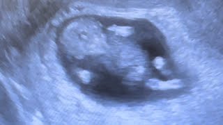 11 week ultrasound - another active baby