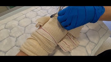 Basal Thumb CMC Joint Arthroplasty - 3 Weeks Post-Op, Removal of Half-Cast Plaster