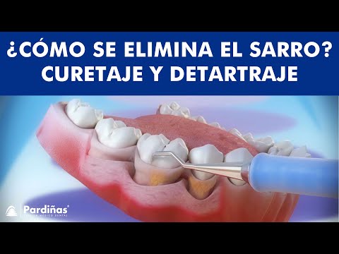 ¿Cómo se ELIMINA EL SARRO? - Curetaje y limpieza dental ©