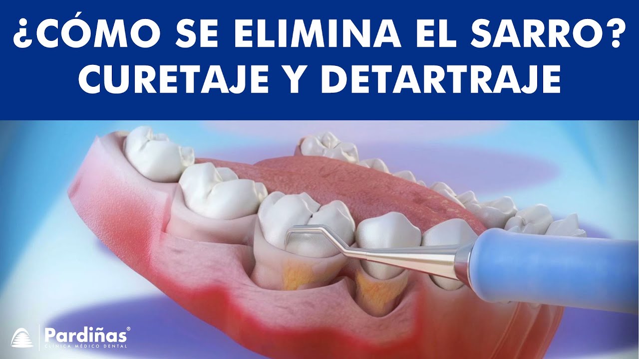 ▷ Limpieza Dental con Ultrasonidos 【Pros y Contras】