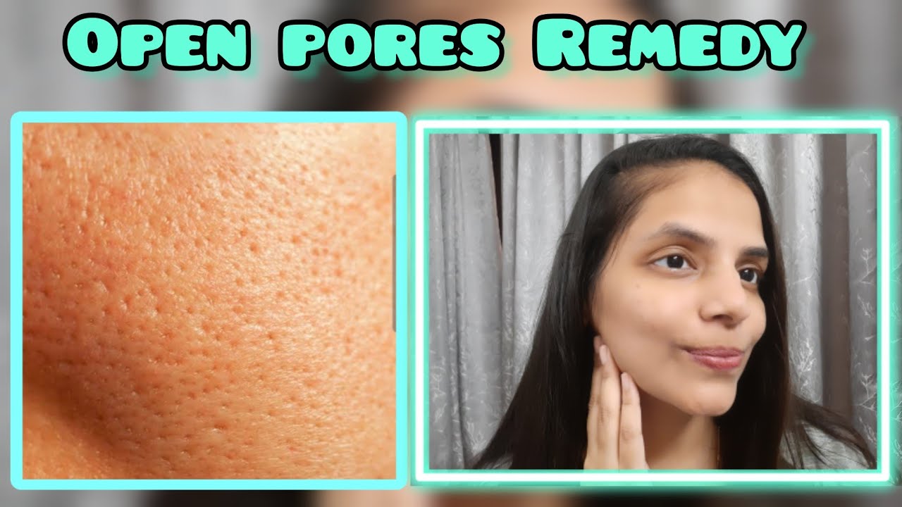 1 Magical Product for Open Pores| Treat Open Pores at home | Seema Chawla